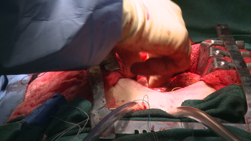 Heart beating during open heart surgery