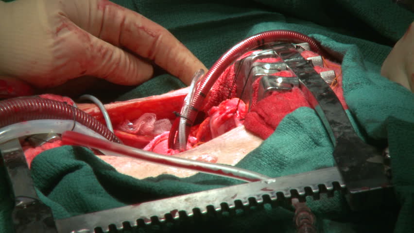 Heart pulses while connected to bypass machine
