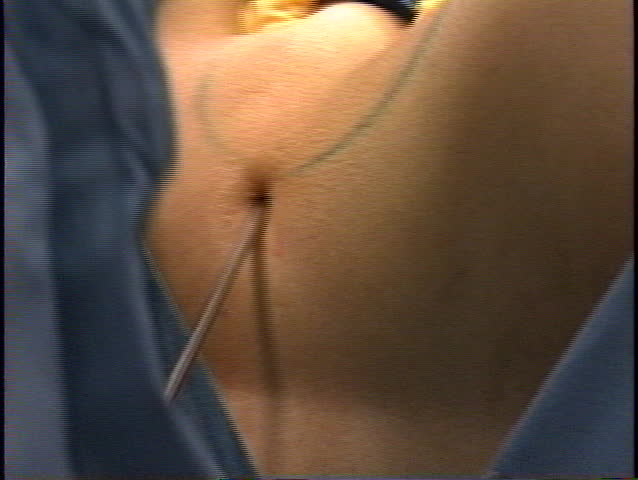Repeated entering and removal of the syringe in patient