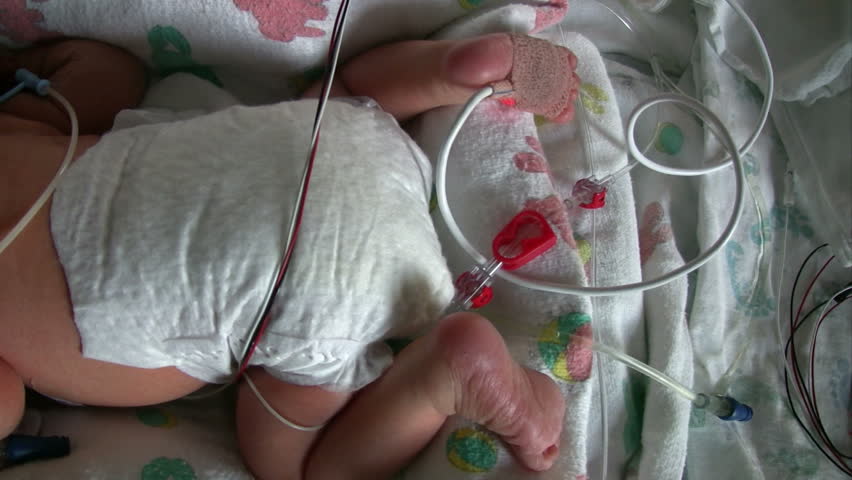 Pan overtop of a newborn premie baby laying in his bed in intensive care.  HD 1080i