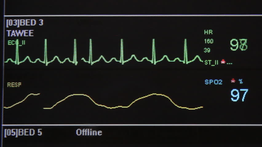 EKG monitor in ICU unit show The waves of blood pressure, blood oxygen saturation, ECG,heart rate