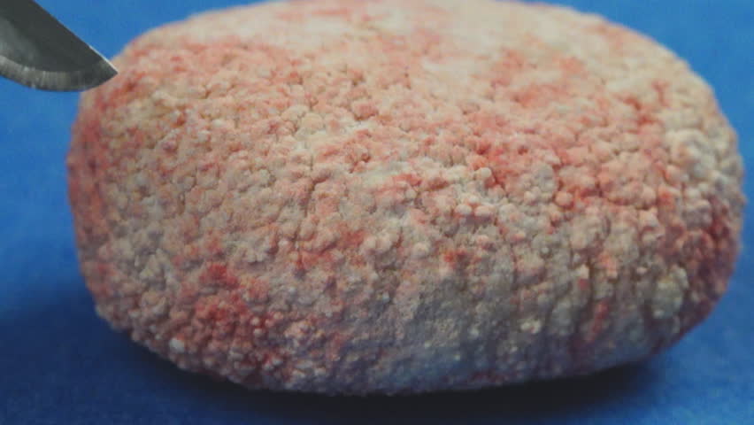 Veterinarian removing extremely large Bladder stone in a dog, calcium oxalate stone due to excessive calcium in diet