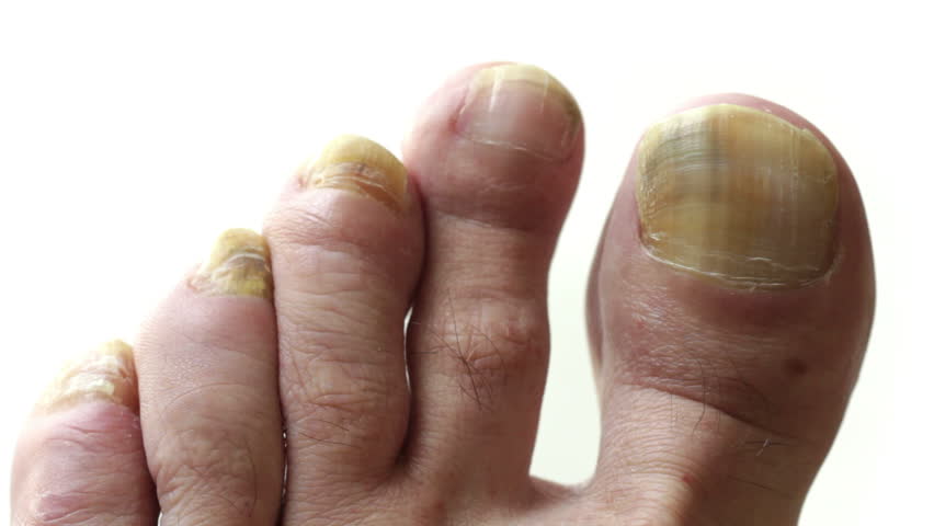 Toenails with common fungal infection. Shot with macro lens and shallow depth of field, white background.