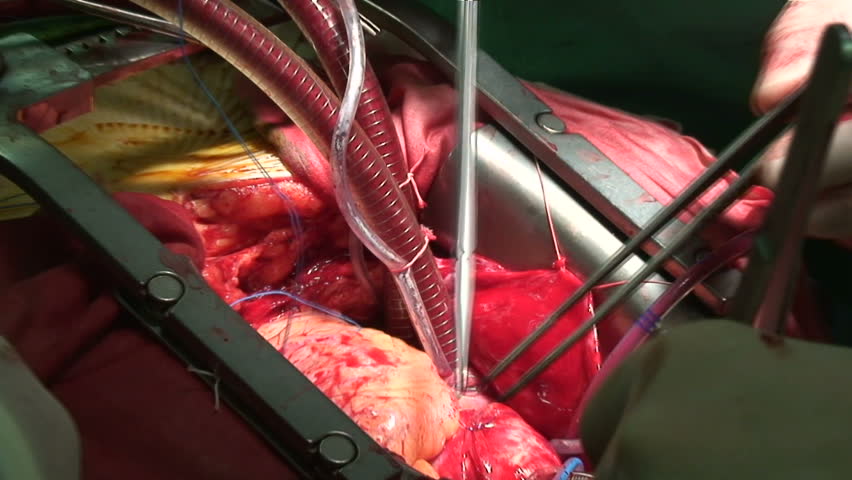 Cardiac surgery. Pacemaker electrodes implantation.
