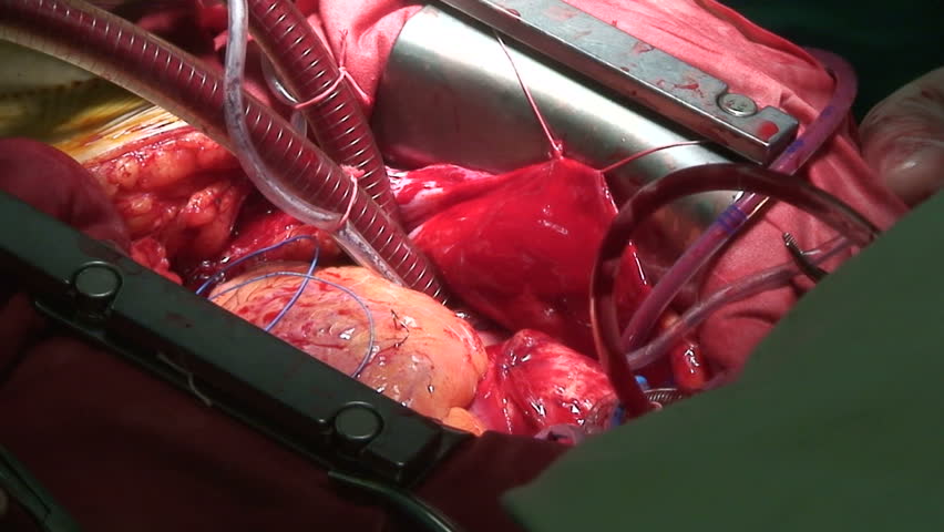 Cardiac surgery. Beating heart and cardiopulmonary bypass.