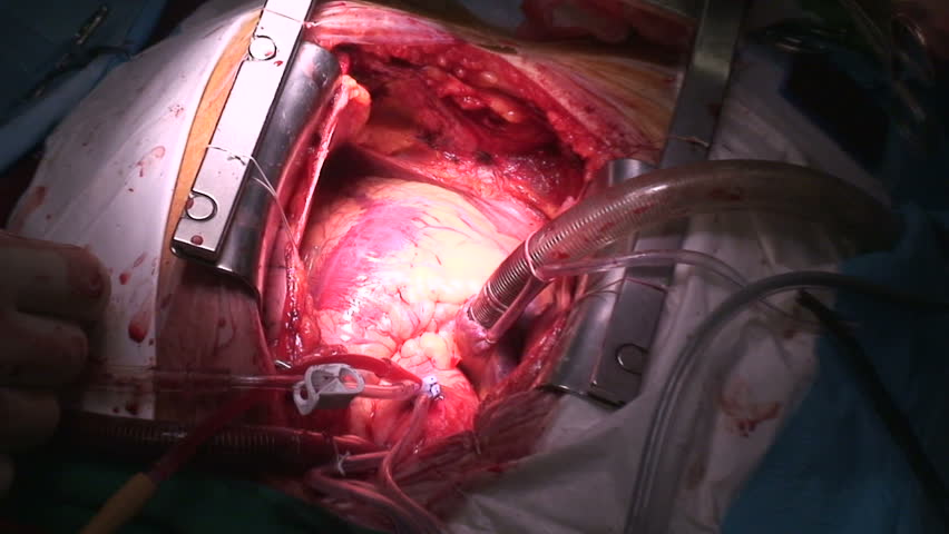 Cardiac surgery. Beating Heart.