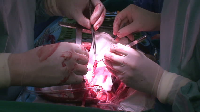 Cardiac surgery. Coronary artery bypass grafting.