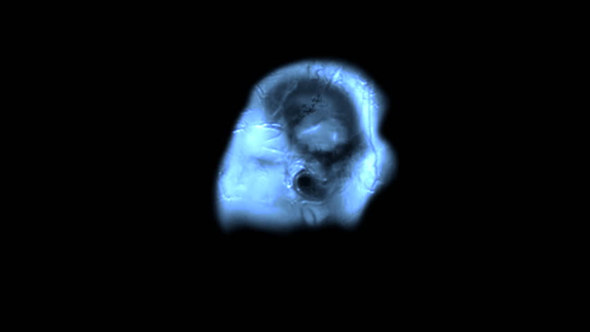 MRI brain scan