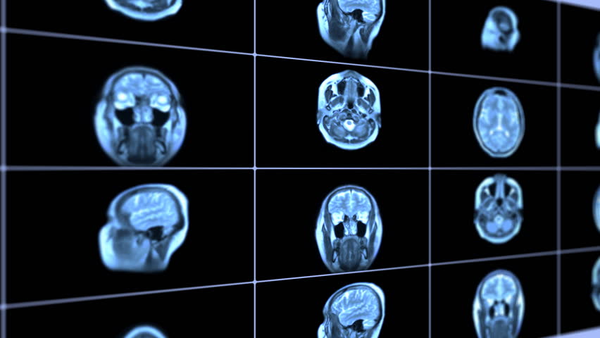 MRI brain scan