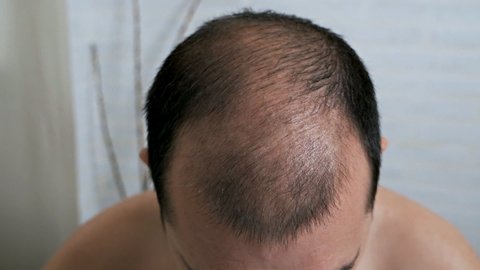 Hair Loss Cure Stock Video Footage 4k And Hd Video Clips