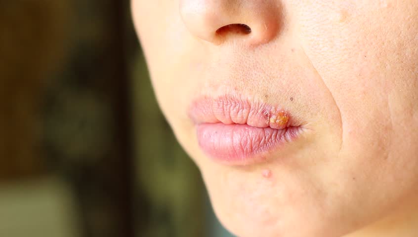 synonym mouth problem definition/meaning Herpes Oral synonym mouth problem definition/meaning Herpes Oral