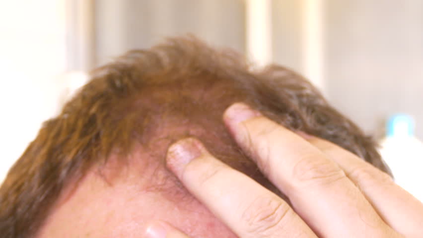 Man Strokes Receding Hairline Closeup Stock Footage Video 100