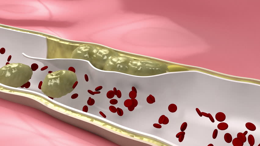 Header of embolus