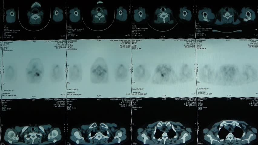 Ct Scan Cancer Lymph Nodes - ct scan machine
