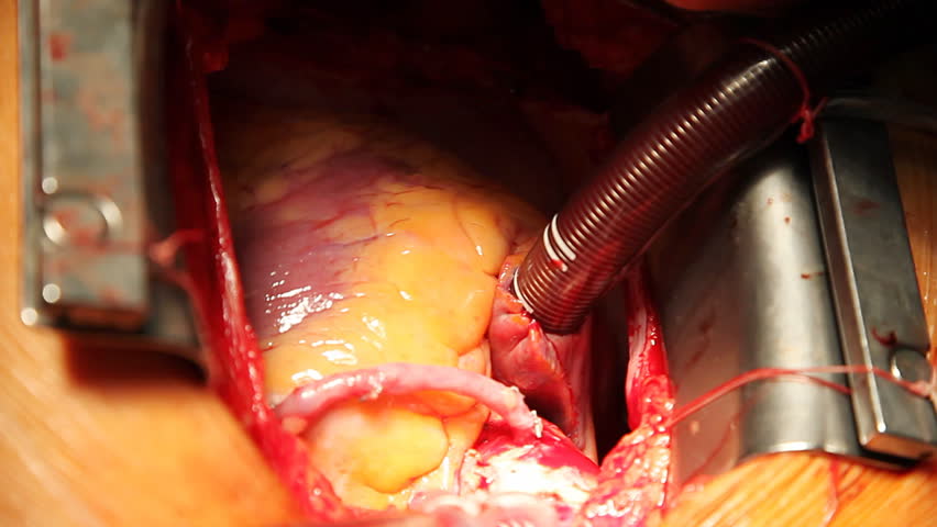 artery coronary grafting